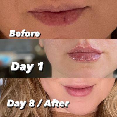 Lip Filler with Restalayne Kysse