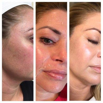 Perfect Derma Peel: Before / During / After