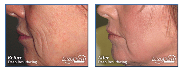 Erbium laser resurfacing