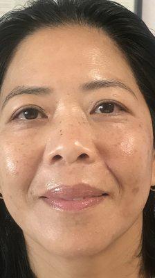 Client after a series of microdermabrasion and light therapy.