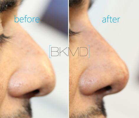 Nose filler