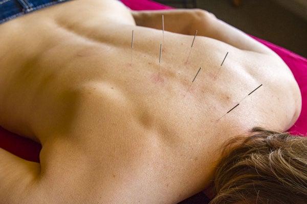 The term acupuncture describes a family of procedures involving stimulation of anatomical points on the body by a variety of techniques.