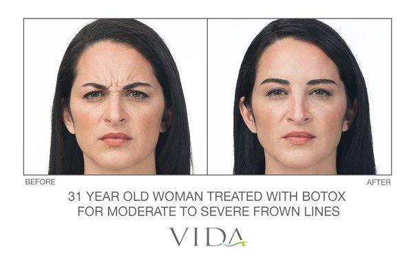 Before and after imagery depicting the natural results Botox provides for the treatment of vertical lines between the brow.