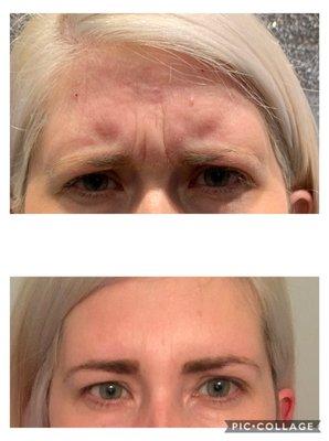 Angry face, top photo is before Botox. No filter!