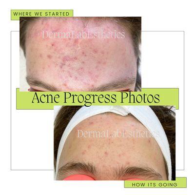 Acne facial treatment progress photos