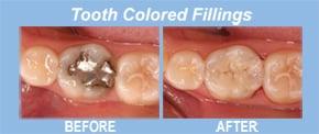 Old silver amalgam fillings tend to darken over time, and can develop cracks or gaps. If replacement is necessary, many patie...