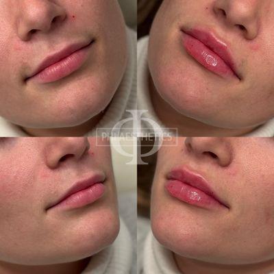 Lip filler Before and After