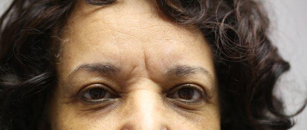 After- Upper Blepharoplasty