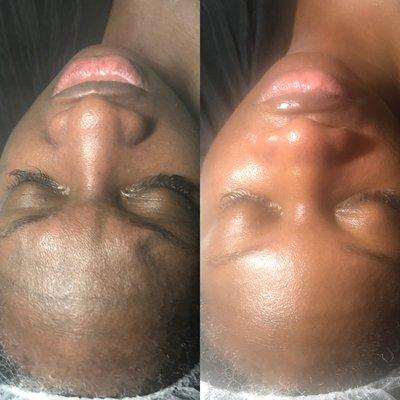 Refined Facial