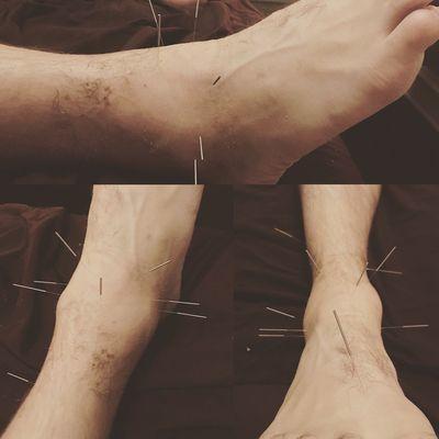 Electro Acupuncture Treatment for Ankle Sprain.