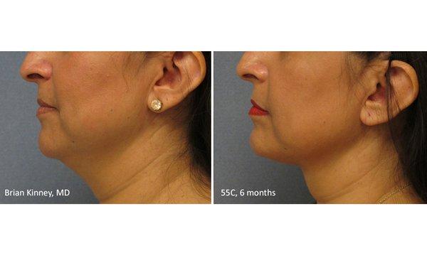 ThermiTight non-invasive skin tightening of the neck