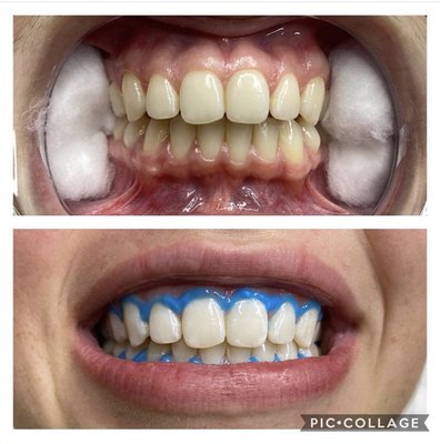 30 minute teeth whitening session