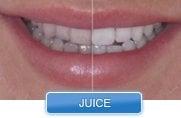 Teeth Whitening Works!!