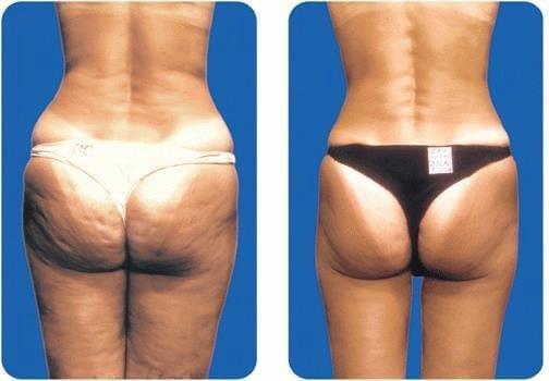 Lipomassage before & after; rid cellulite, tighten & shape skin!