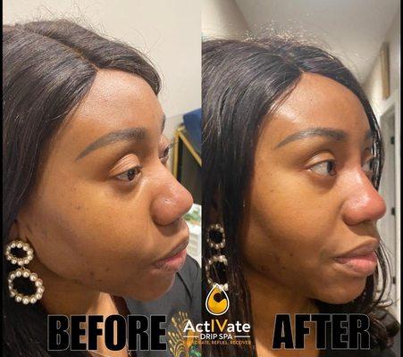 Non-surgical Rhinoplasty