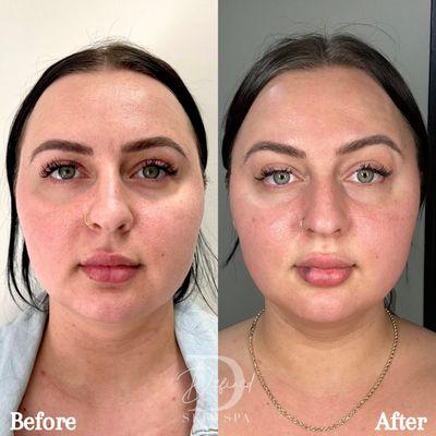 Full Facial Balancing with Botox & Filler (2 Days Post-Treatment)