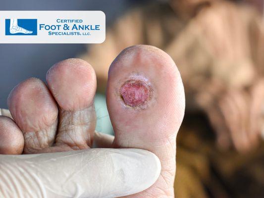 Foot Ulcer Treatment