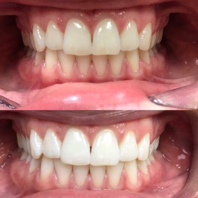 Teeth whitening results