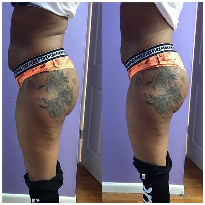 Laser Lipo and butt enhancement package results after 1 treatment!!!