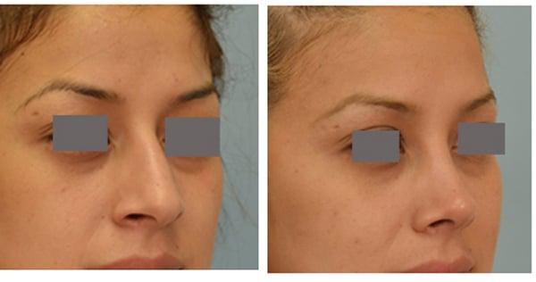 Closed rhinoplasty by Dr. Grigoryants