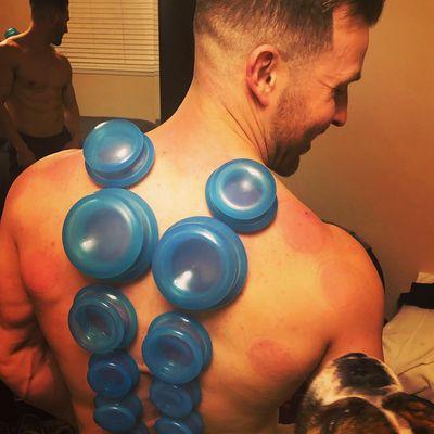 Cupping therapy for better sleep