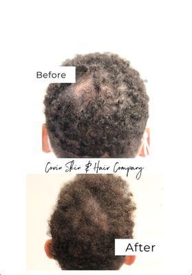 Micro Scalp Pigmentation