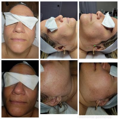 Chemical peel series
Bottom before
Top after
Noticeable improvement in hyperpigmentation and uneven skin tone.