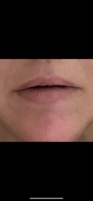 After lip filler session , no results