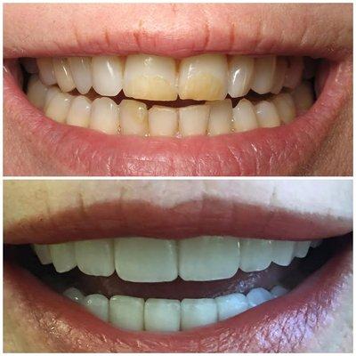 Cosmetic Veneers on a patient.