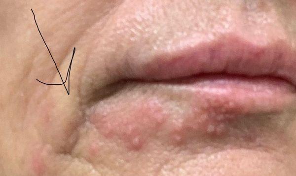 Excess filler and lip trauma from injection.