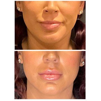 Before and after: Lip filler. Results vary with each individual patient.