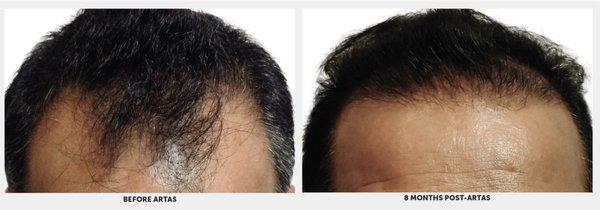 Before and after results of the Robotic Hair Restoration procedure.