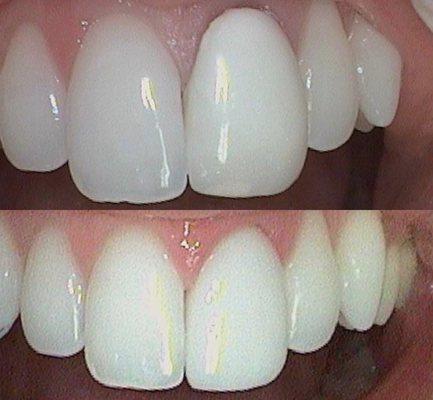 Old crown was bulky and had dark line at the gum area. We replaced it with a natural looking porcelain crown.