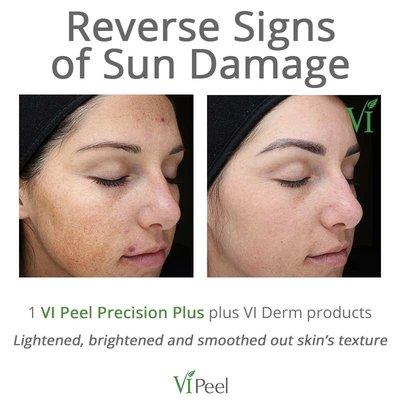 Vi Peel and Derm