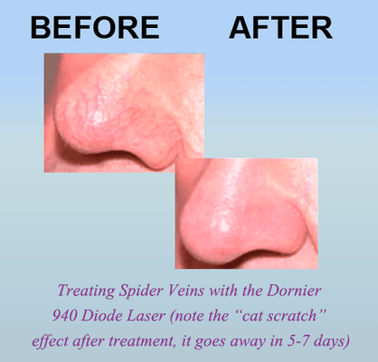 Treating spider veins with the Dornier 940 Diode Laser