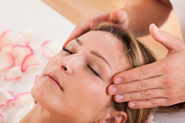 Cosmetic Acupuncture