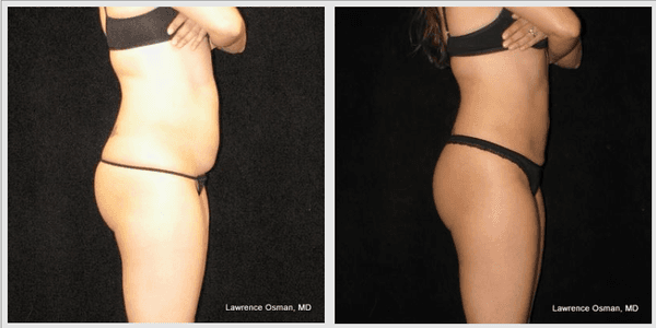 Abdominal liposuction