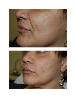 What a HUGE difference! Feel more confident with immediate results by using Radiesse!