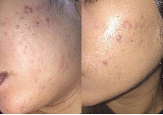 Acne peel