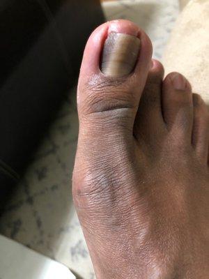 Guy removed 1/4 of my toenail