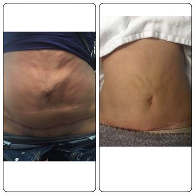 Tummy tuck treatment with the Venus Versa