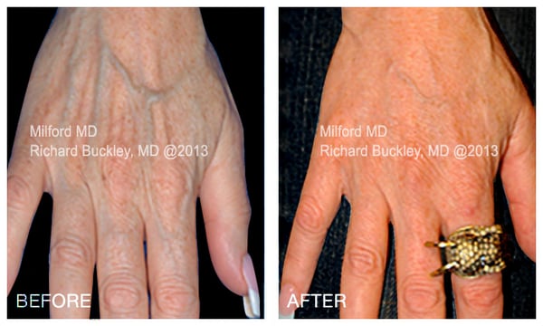 Before and After Hand Rejuvenation - MilfordMD