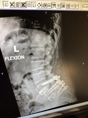 l4, l5, S1 Spinal fusion surgery