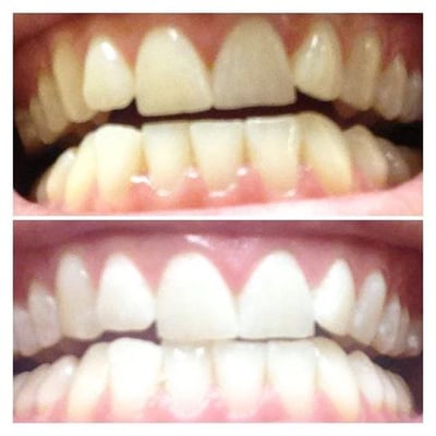 before and after 60 minute whitening session