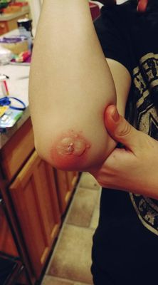 Dr. Germanas caused 2nd degree burns on my son's arm, instead of just treating a wart.