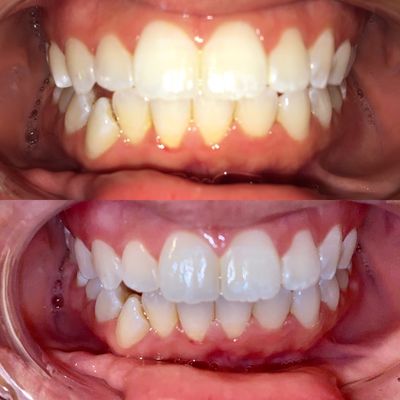 60 min teeth whitening session