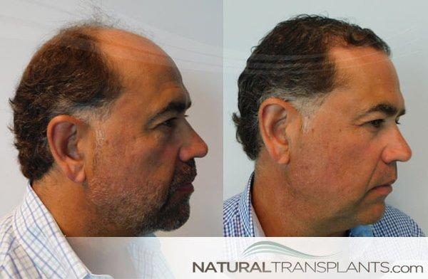 Best Hair Transplant In Usa