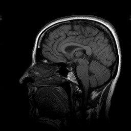 MRI of the brain