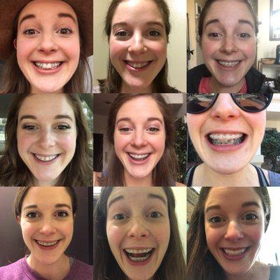 This is a lot of selfies, but DANG. Every visit, starting with the decision to get braces, was worth it. 16 months of great treatment!!