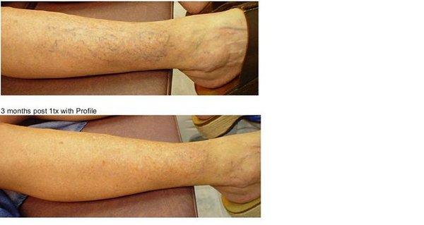 Spider Vein Treatment